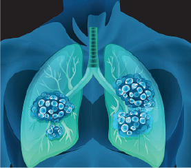 肺のイメージ画像